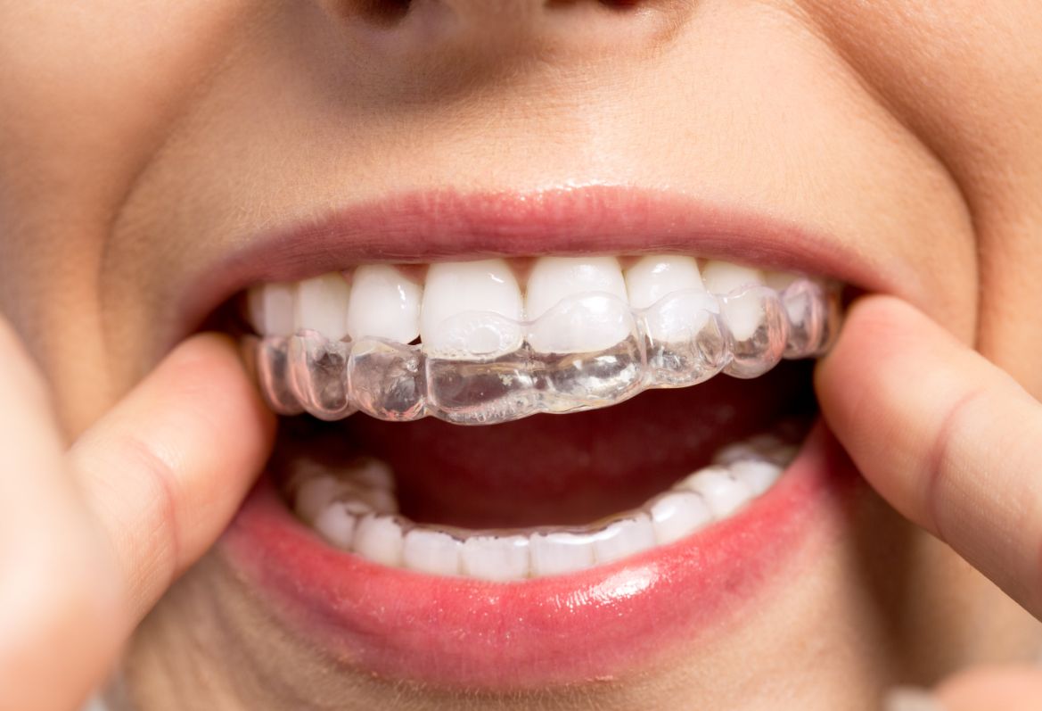 ortodonzia trasparente | Studio Bernardi Odontoiatri Bologna